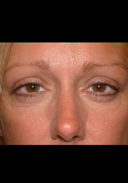 BrowLift – Case 3
