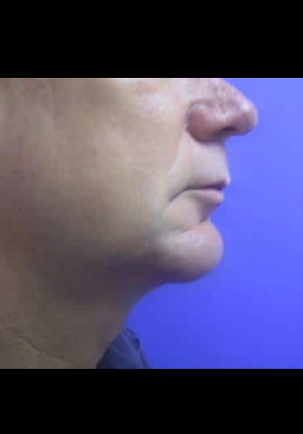 Chin Implant – Case 2