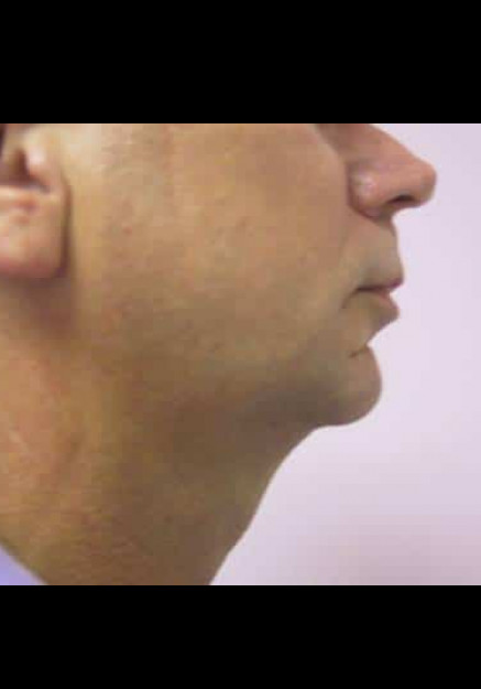 Chin Implant – Case 2