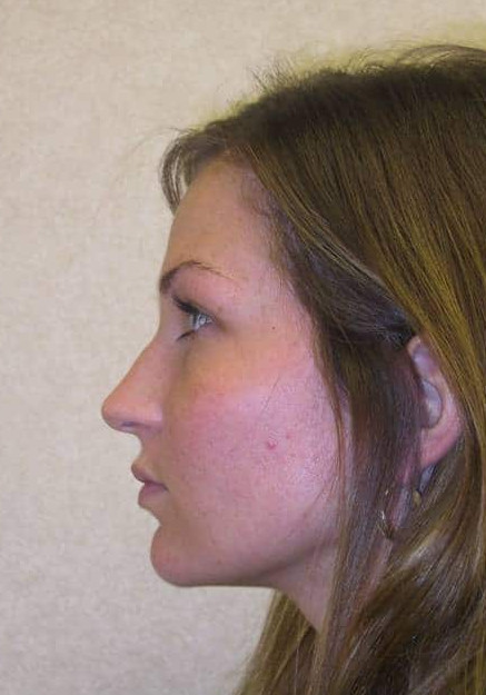 Chin Implant – Case 3