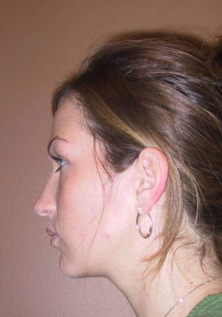 Chin Implant – Case 3