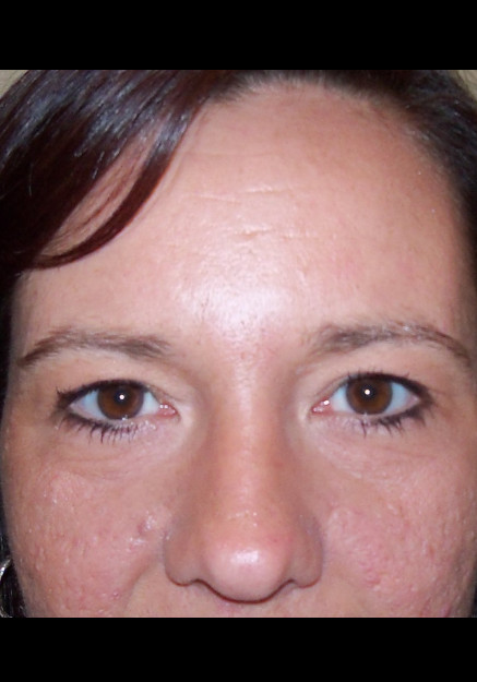 Eyelid Surgery – Case 2