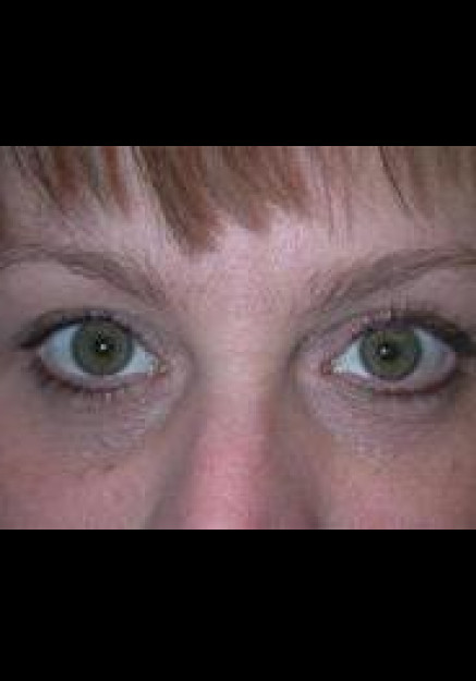 Eyelid Surgery – Case 3