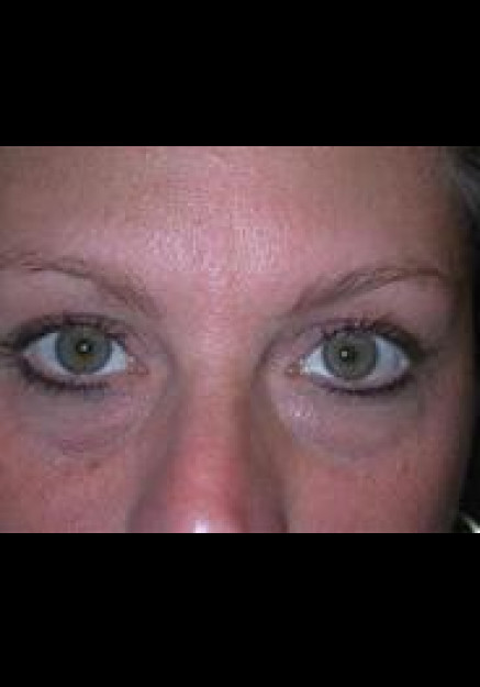 Eyelid Surgery – Case 3
