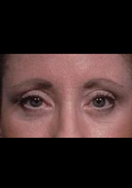 Eyelid Surgery – Case 5