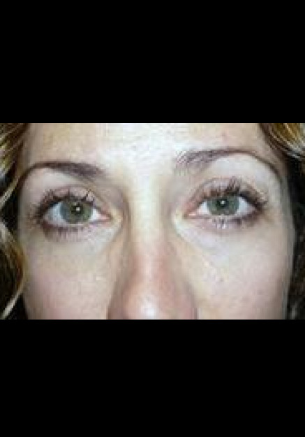 Eyelid Surgery – Case 6