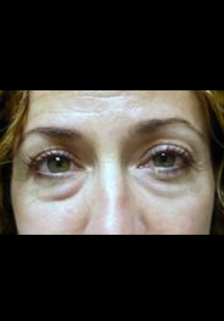 Eyelid Surgery – Case 6