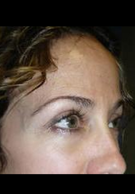 Eyelid Surgery – Case 7