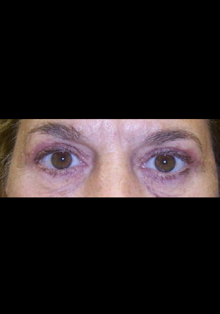 Eyelid Surgery – Case 8