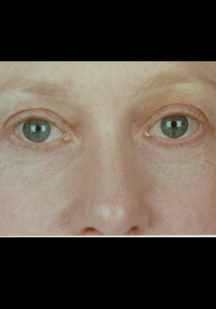 Eyelid Surgery – Case 10