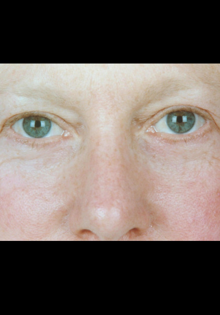 Eyelid Surgery – Case 10