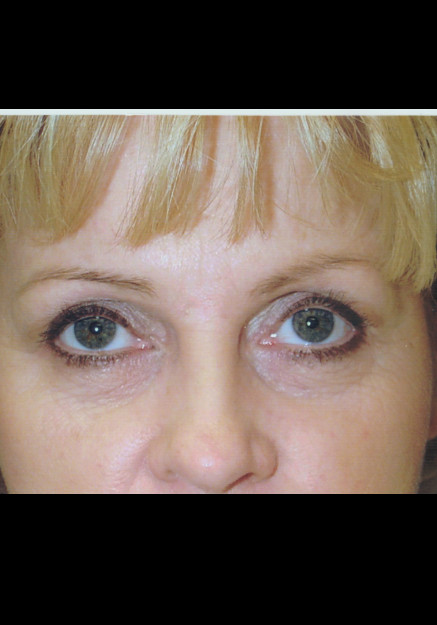 Eyelid Surgery – Case 11