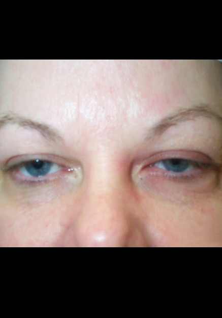 Eyelid Surgery – Case 12