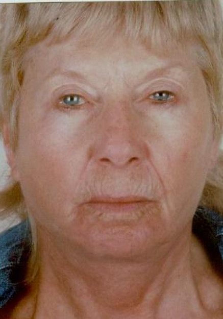Face Lift Surgery – Case 1