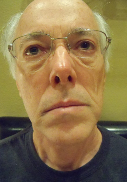 Face Lift Surgery – Case 2