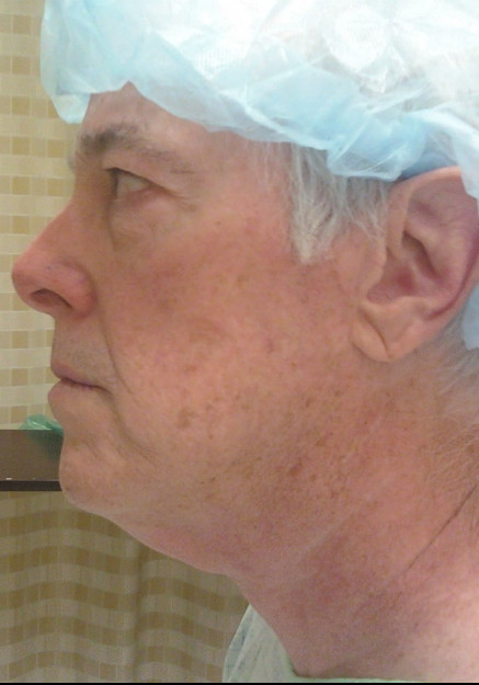 Face Lift Surgery – Case 2