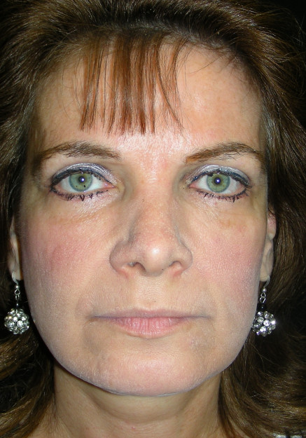 Face Lift Surgery – Case 3