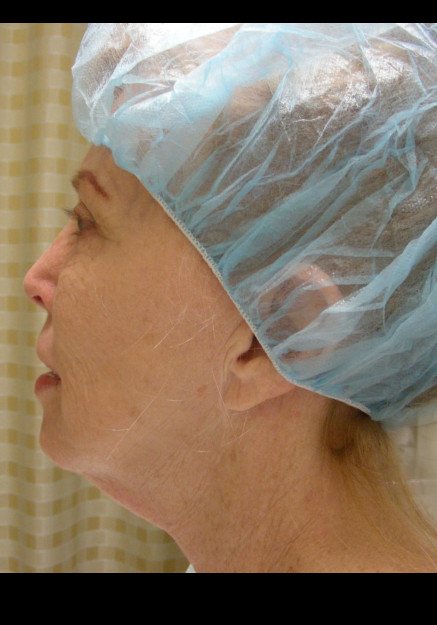 Face Lift Surgery – Case 4