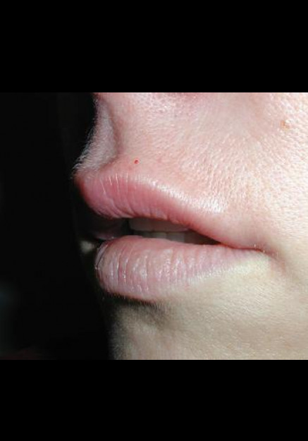 Restylane – Case 3