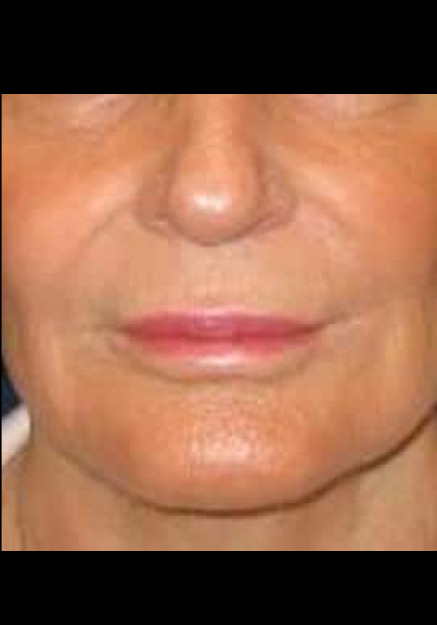 Restylane – Case 4