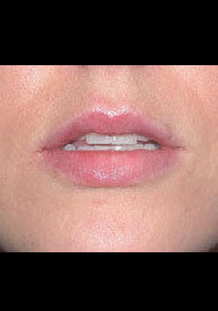 Restylane – Case 5