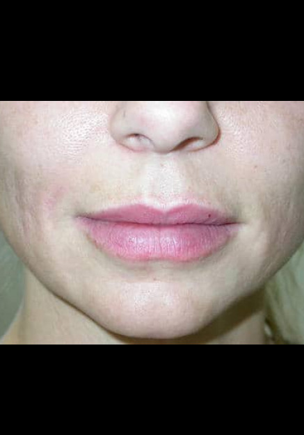 Restylane Case 6