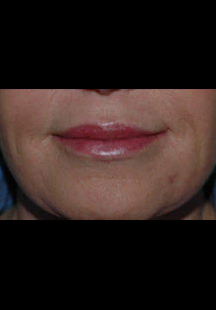 Restylane – Case 7