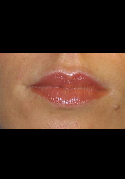 Restylane – Case 8