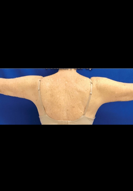 Renuvion Skin Tightening-Case 1