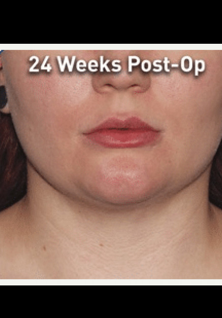 Renuvion Skin Tightening-Case 3