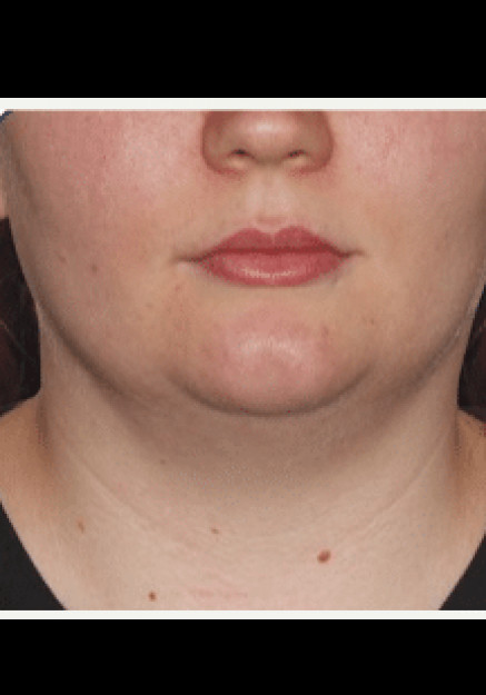 Before Image: Renuvion Skin Tightening-Case 3