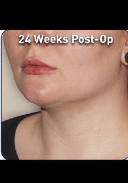 Renuvion Skin Tightening-Case 3