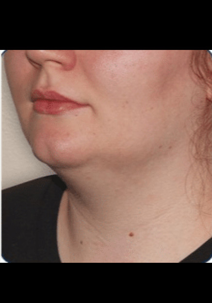 Renuvion Skin Tightening-Case 3