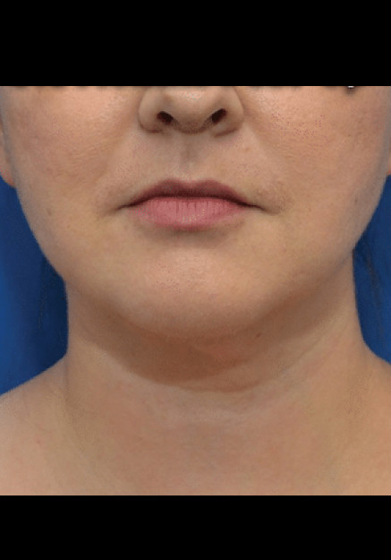 Renuvion Skin Tightening-Case 5