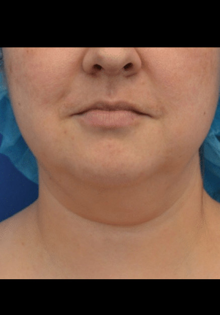 Renuvion Skin Tightening-Case 5