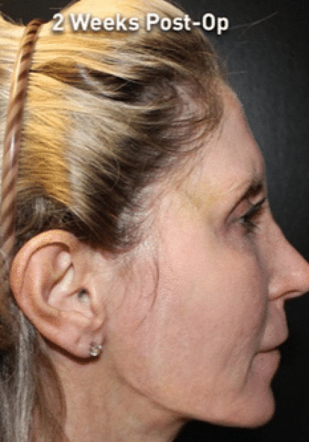 Renuvion Skin Tightening-Case 6