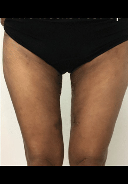 Renuvion Skin Tightening-Case 7