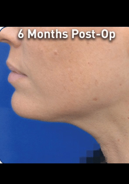 Renuvion Skin Tightening-Case 8