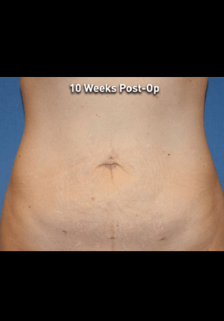 Renuvion Skin Tightening-Case 9