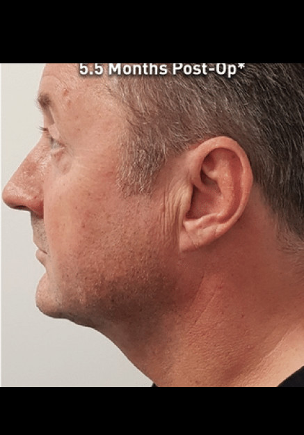 Renuvion Skin Tightening-Case 11