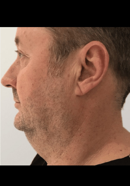 Renuvion Skin Tightening-Case 11