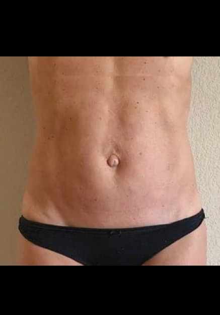 Renuvion Skin Tightening-Case 12