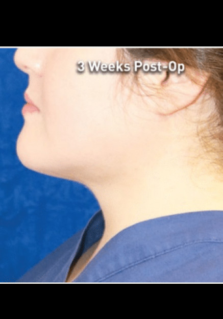 Renuvion Skin  Tightening-Case 13