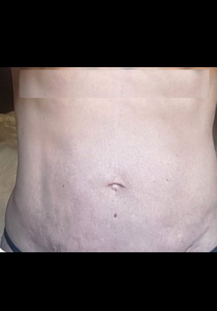 Renuvion Skin Tightening-Case 14