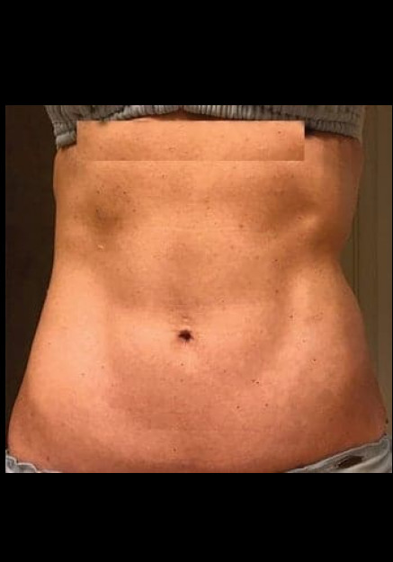 Renuvion Skin Tightening-Case 15