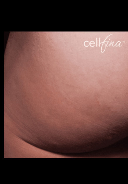 Cellfina – Case 3
