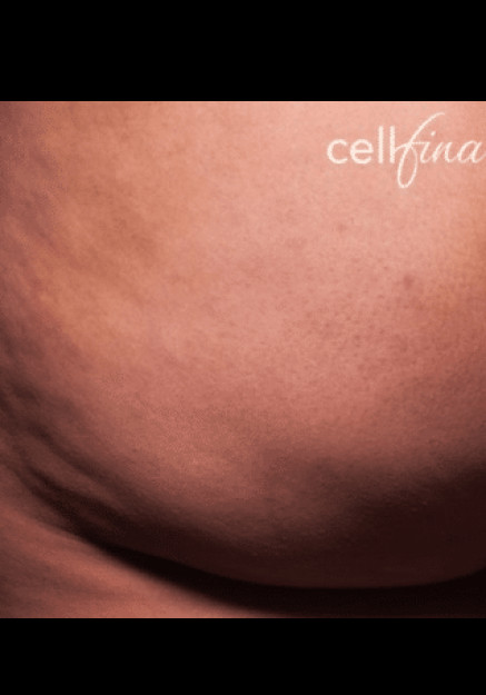 Cellfina – Case 4
