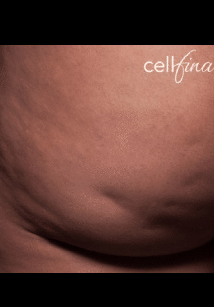 Cellfina – Case 4