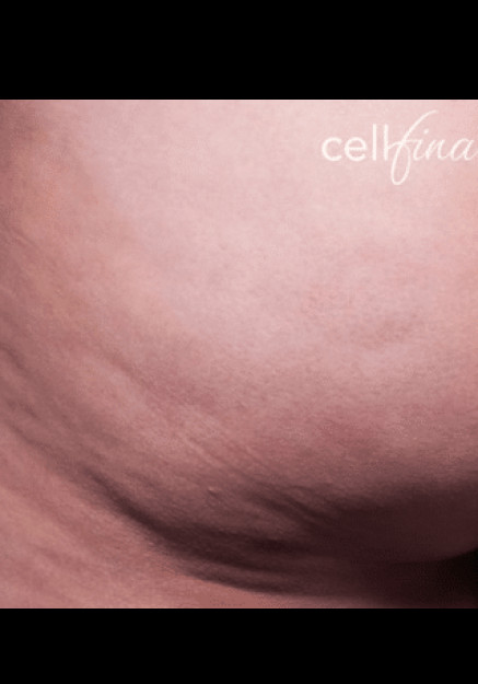 Cellfina – Case 5