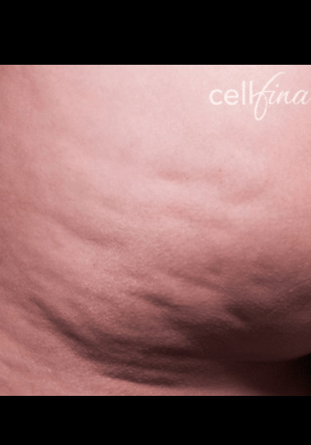 Cellfina – Case 5